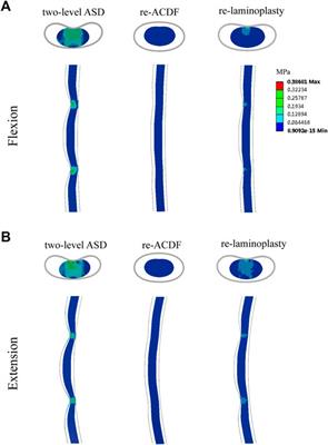 Biomechanical Evaluation of Different Surgical Approaches for the Treatment of Adjacent Segment Diseases After Primary Anterior Cervical Discectomy and Fusion: A Finite Element Analysis